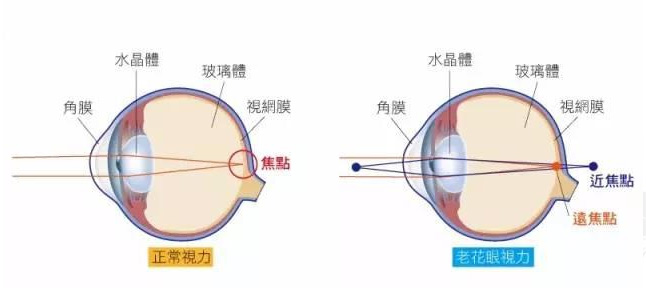 白內(nèi)障和老花眼區(qū)別，老花眼發(fā)病率正呈現(xiàn)年輕化趨勢(shì)